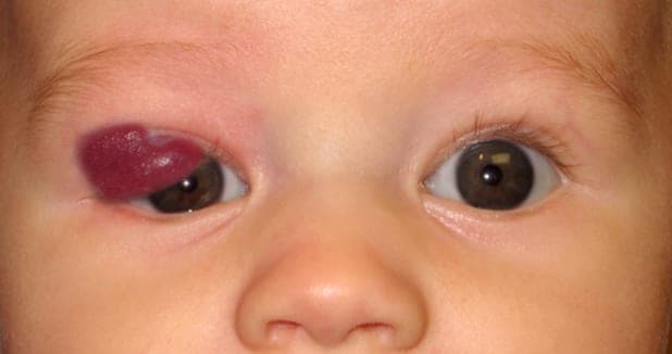 Capillary hemangioma of the eyelid before timolol treatment